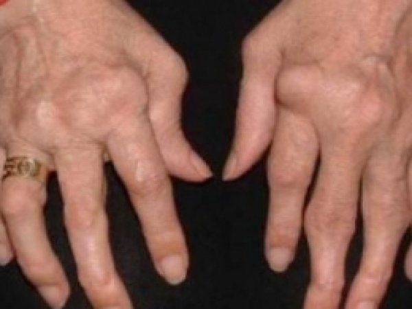 Eklem İltihabı Kadınlarda Daha Çok Görülüyor 