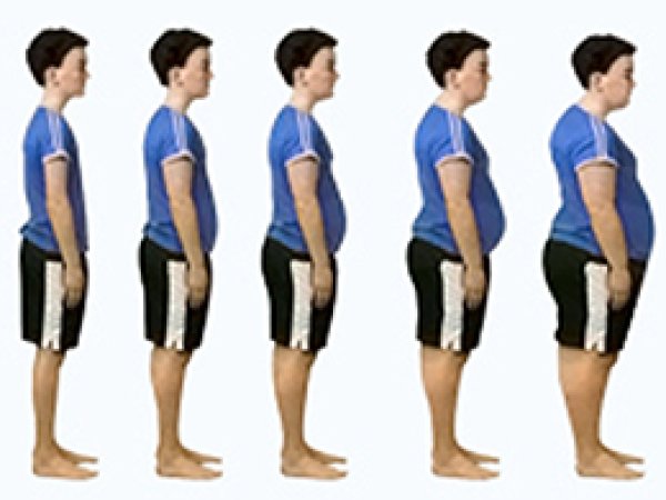 Obezite Nedir?