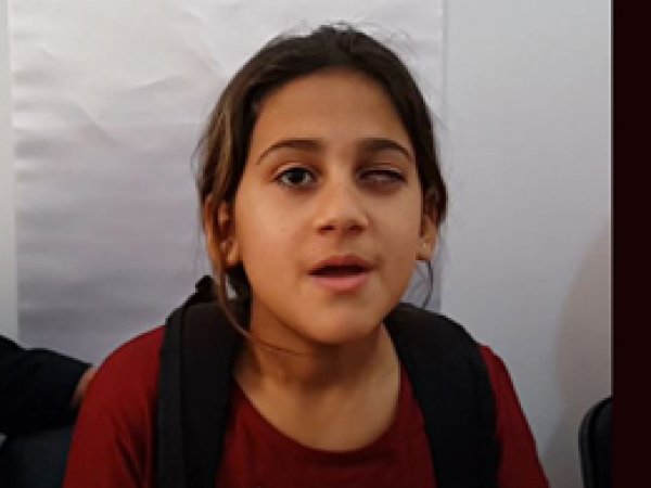 Gözünü kaybeden kıza suni göz takıldı