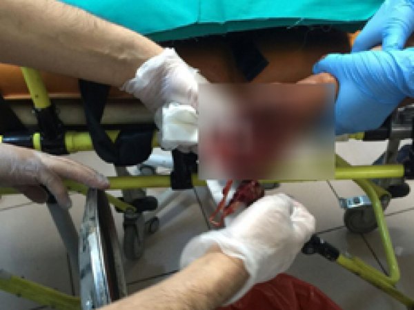 Elinde torpil patlayan genç yaralandı