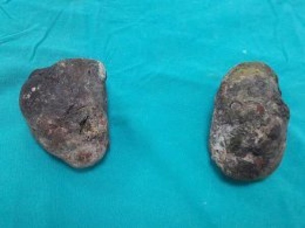 Midesinden 400 gram ağırlığında 2 taş çıkarıldı
