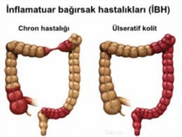 İnflamatuvar bağırsak hastası olabilirsiniz!