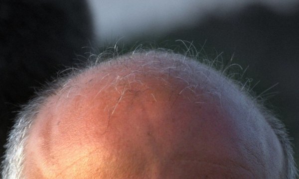 'Uzun saatler boyunca çalışmak kel olma riskini iki kat artırıyor'