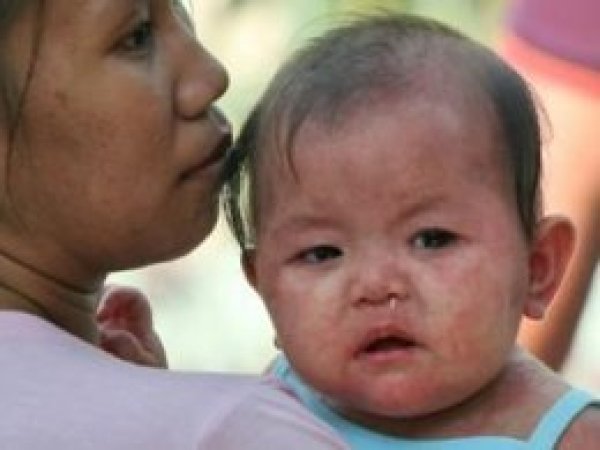 Filipinler'de kızamık salgını: 203 ölü