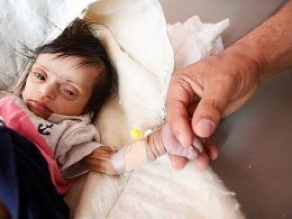 Yemen’de 20 milyon kişi sağlık hizmetlerinden mahrum 
