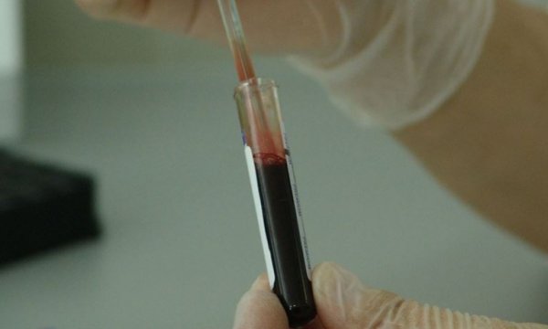 Tek kan testiyle 20 kanser türü tespit edilebiliyor
