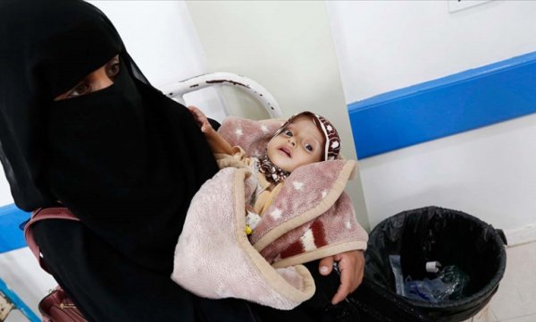 DSÖ: Yemenli çocukların yüzde 75'i yetersiz beslenmeden muzdarip