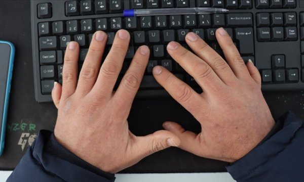 Kargo paketlerini 12 parmağıyla teslim alıyor