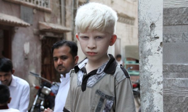 Albinizmli bireyler, dünya genelinde insan hakları ihlallerine maruz kalıyor