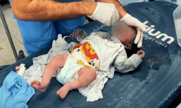 Gazzeli doktorlar anestezi olmadan ameliyat yapıyor 