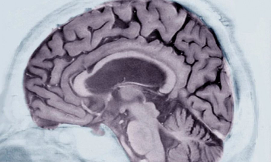 Alzheimer erken dönemde kelime tercihi ve yazı davranışlarında kendini belli ediyor